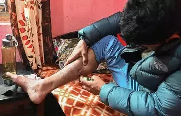 Surya Sharma, who joined the Russian army as a mercenary to fight in the invasion of Ukraine and asked to use a pseudonym for legal reasons, shows a combat injury during an interview with AFP at his rented residence in Kathmandu on February 6. [Prakash Mathema/AFP]